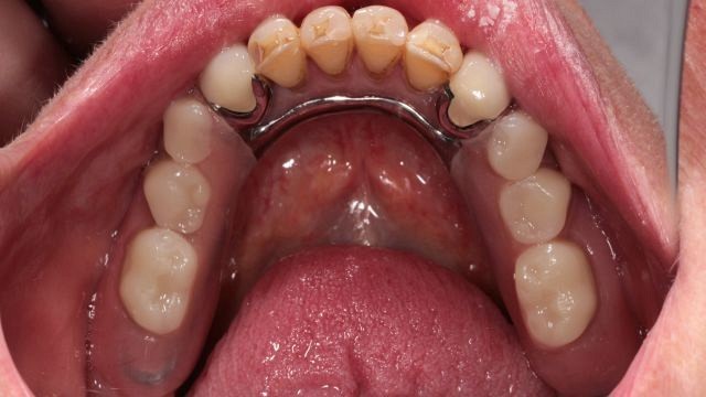 Teeth 
      Extractions For Dentures Hightstown NJ 8520